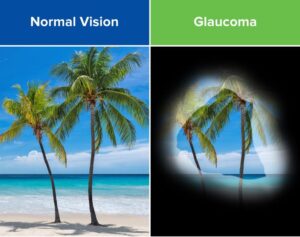 Glaucoma Awareness: Understanding, Early Detection, and Treatment